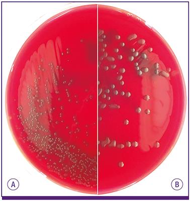 Sugar-Coated Killer: Serotype 3 Pneumococcal Disease